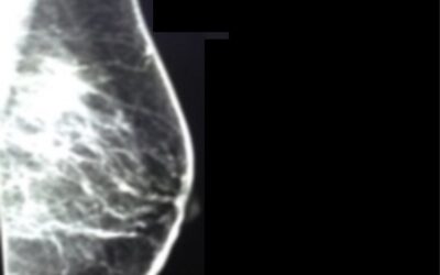 Breast Cancer, Early Detection, and You
